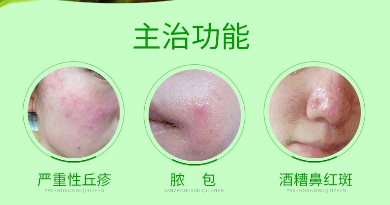 丽芙 甲硝唑凝胶 20g 2